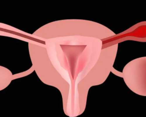 卵巢早衰查amh还是激素六项&做试管一次能怀孕吗,多囊卵巢综合症出现时的原因