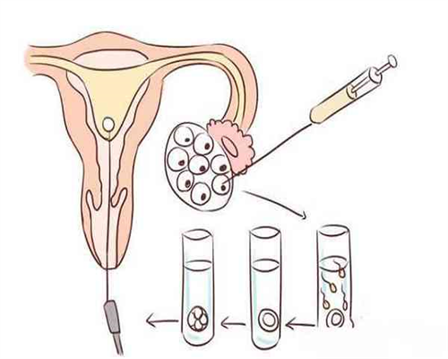 试管穿刺一次取多少精&什么是供卵,南昌供卵助孕机构人工受孕生双胞胎费用多